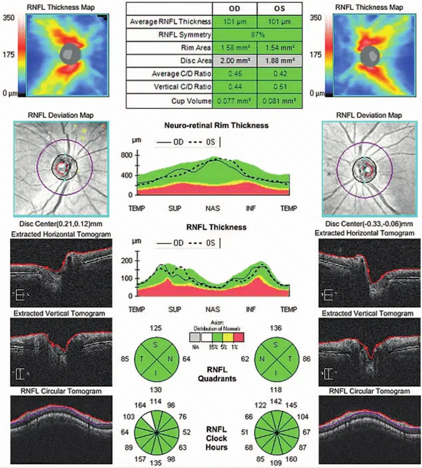 Glaucoma test results