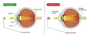 side-by-side diagram of normal versus astigmatic eye showing multiple focal points and causes of blurry vision