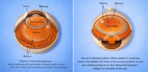 Diagram showing corect bubble placment in the eye for safe retinal surgery recovery at Barnet Dulaney Perkins in Phoenix, Arizona.
